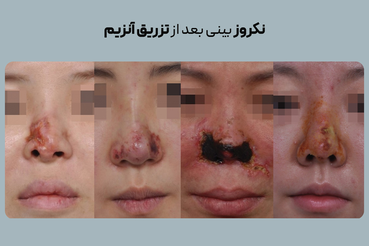 نکروز بینی بعد از تزریق آنزیم