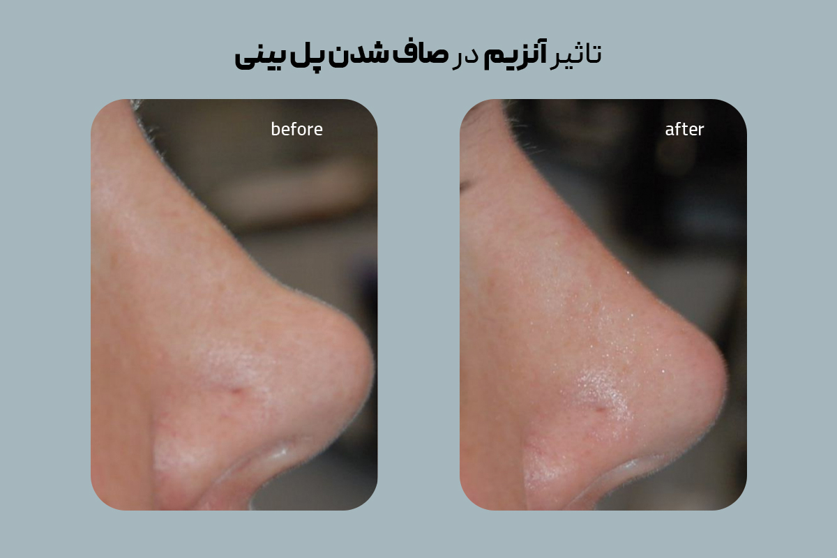 تاثیر آنزیم در قبل و بعد آنزیم بینی