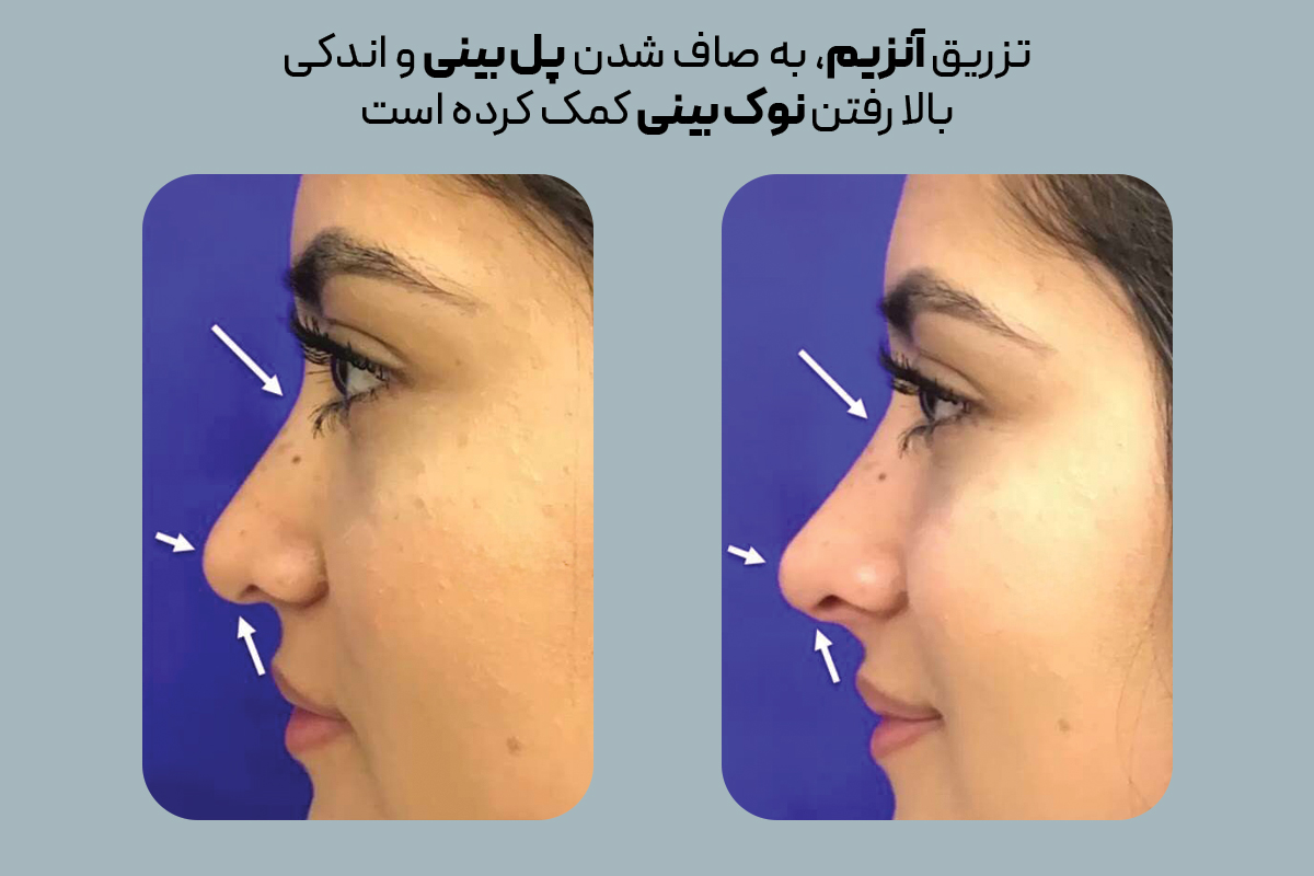 تزریق آنزیم به بینی