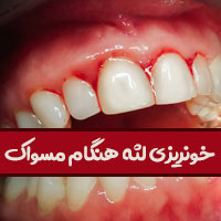 علت خونریزی لثه هنگام مسواک زدن