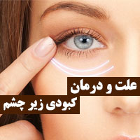 علت کبودی زیر چشم