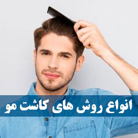 روش کاشت مو