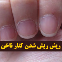 پوسته شدن اطراف ناخن
